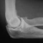 X-ray image of elbow osteoarthritis.